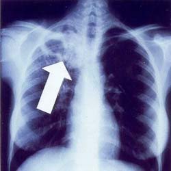 sputum test may not hold key to tb eradication study sputum test